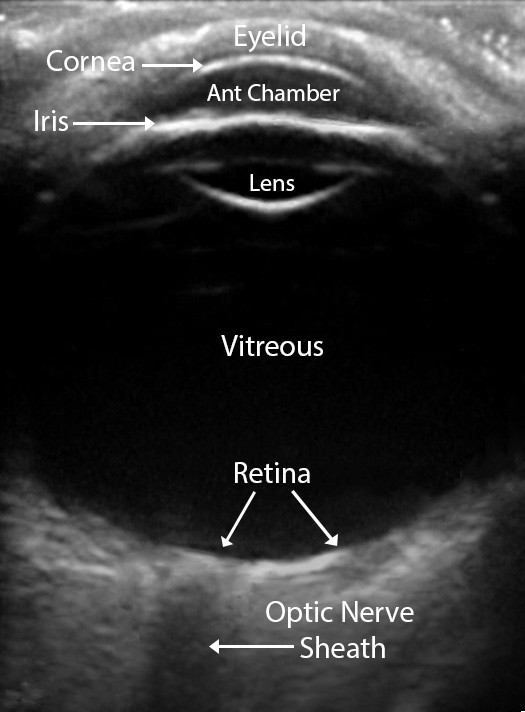 ultrasound eye ocular icp intracranial pressure elevated detecting using lens posterior cornea keeping nerve optic probe onsd labeled iris ninja